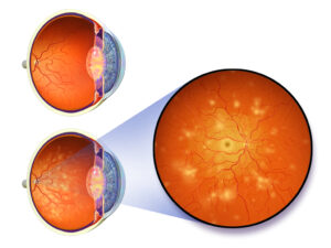retinopatija